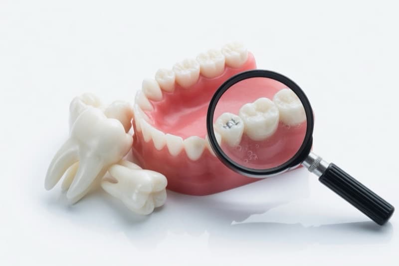 A model of the lower teeth beside two extracted molars, with a magnifier held over one of the back teeth.